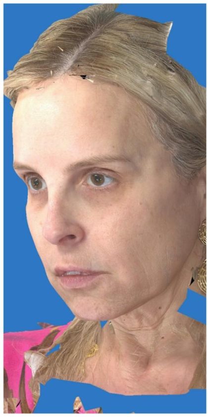 Aesthetic Facial Balancing Before & After Patient #1118