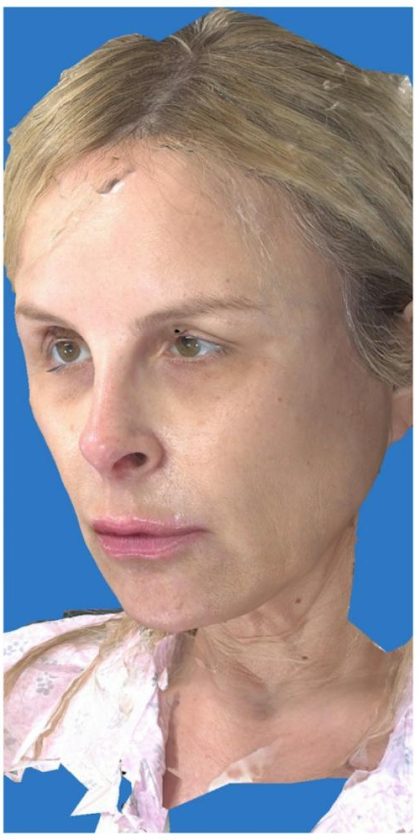 Aesthetic Facial Balancing Before & After Patient #1118