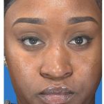 Aesthetic Facial Balancing Before & After Patient #1117