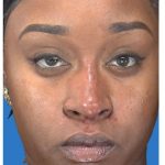 Aesthetic Facial Balancing Before & After Patient #1117