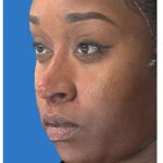 Aesthetic Facial Balancing Before & After Patient #1117
