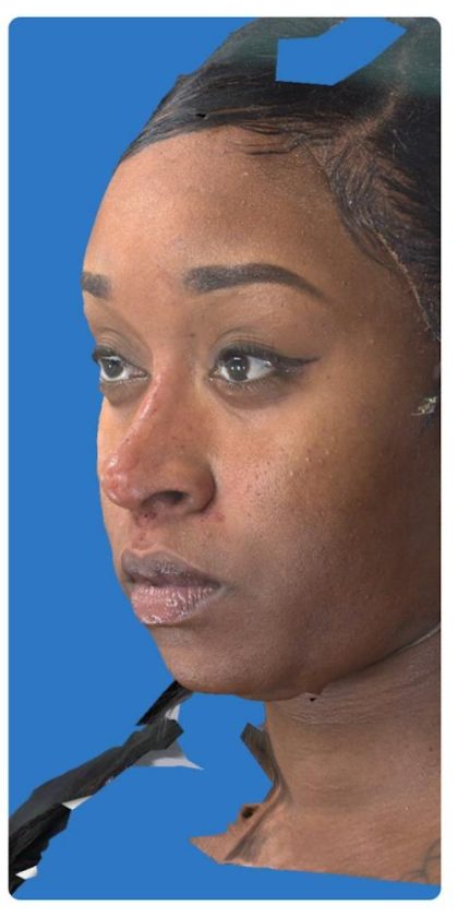 Aesthetic Facial Balancing Before & After Patient #1117