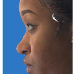 Aesthetic Facial Balancing Before & After Patient #1117