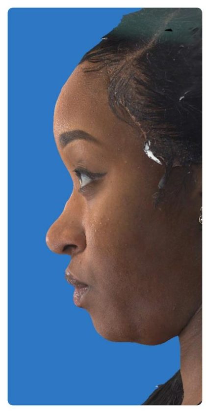 Aesthetic Facial Balancing Before & After Patient #1117