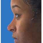 Aesthetic Facial Balancing Before & After Patient #1117