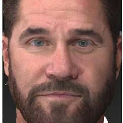 Aesthetic Facial Balancing Before & After Patient #1116