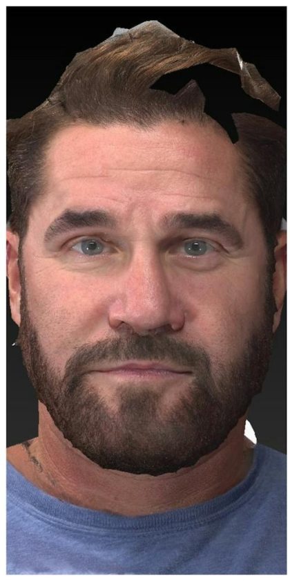 Aesthetic Facial Balancing Before & After Patient #1116