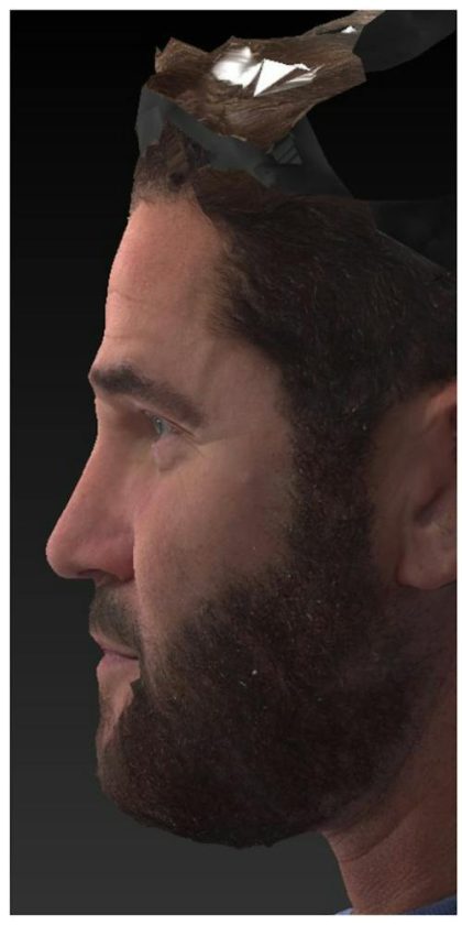 Aesthetic Facial Balancing Before & After Patient #1116