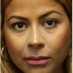 Aesthetic Facial Balancing Before & After Patient #1115