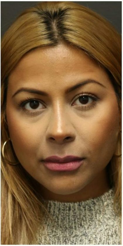 Aesthetic Facial Balancing Before & After Patient #1115