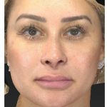 Aesthetic Facial Balancing Before & After Patient #1114