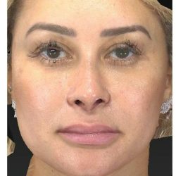 Aesthetic Facial Balancing Before & After Patient #1114