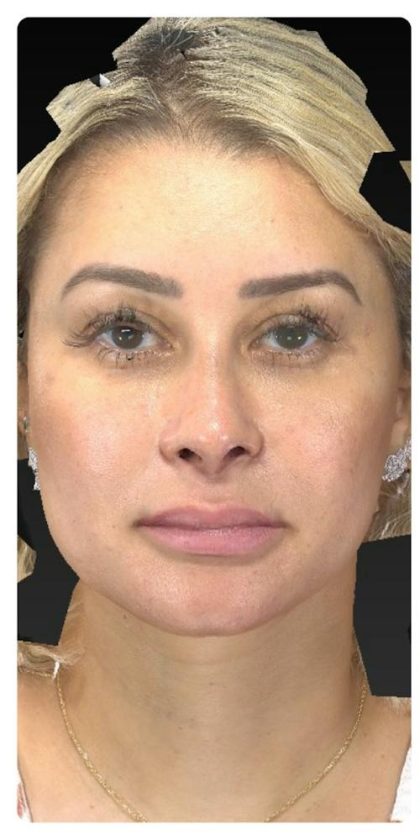 Aesthetic Facial Balancing Before & After Patient #1114