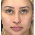 Aesthetic Facial Balancing Before & After Patient #1114