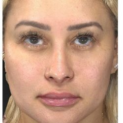 Aesthetic Facial Balancing Before & After Patient #1114