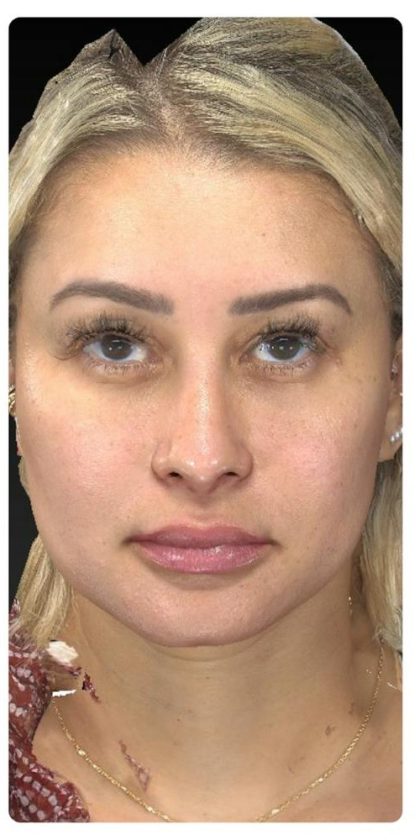 Aesthetic Facial Balancing Before & After Patient #1114