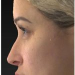 Aesthetic Facial Balancing Before & After Patient #1114