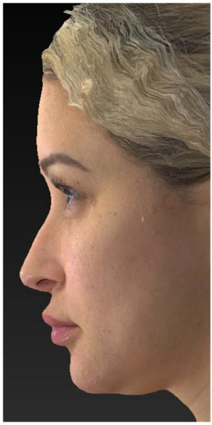 Aesthetic Facial Balancing Before & After Patient #1114