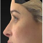 Aesthetic Facial Balancing Before & After Patient #1114