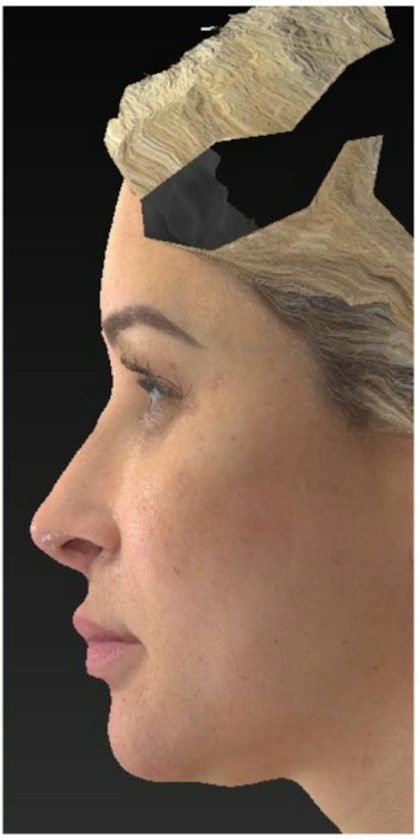 Aesthetic Facial Balancing Before & After Patient #1114