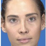 Aesthetic Facial Balancing Before & After Patient #1113