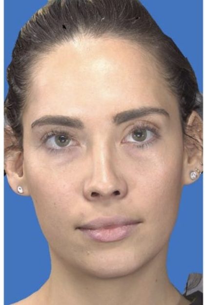 Aesthetic Facial Balancing Before & After Patient #1113