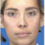 Aesthetic Facial Balancing Before & After Patient #1113
