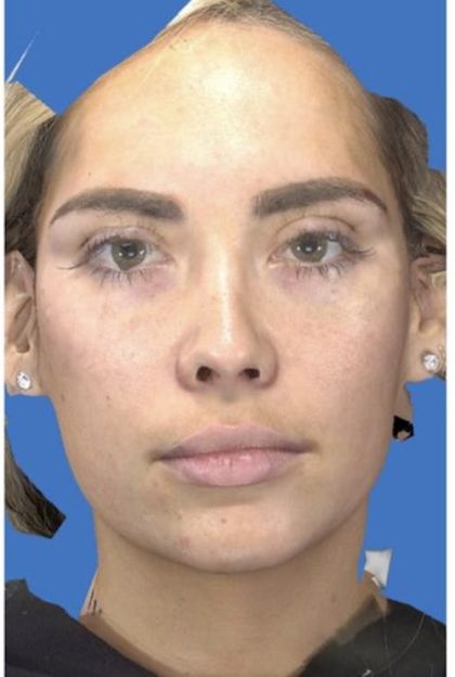 Aesthetic Facial Balancing Before & After Patient #1113