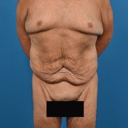 Body Contouring Before & After Patient #1291