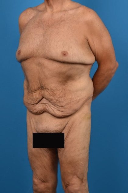 Body Contouring Before & After Patient #1291