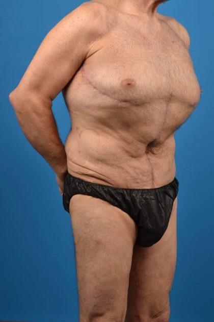 Body Contouring Before & After Patient #1291