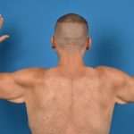 Brachioplasty Before & After Patient #1337
