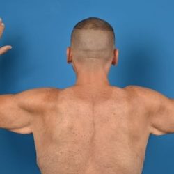 Brachioplasty Before & After Patient #1337
