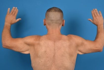 Brachioplasty Before & After Patient #1337