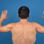 Brachioplasty Before & After Patient #1337