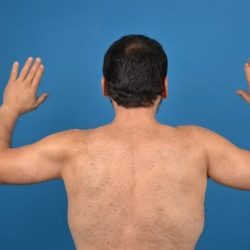 Brachioplasty Before & After Patient #1337