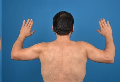 Brachioplasty Before & After Patient #1337