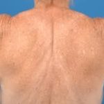 Brachioplasty Before & After Patient #1336
