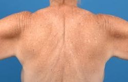 Brachioplasty Before & After Patient #1336