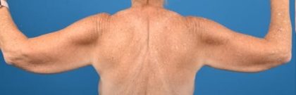 Brachioplasty Before & After Patient #1336