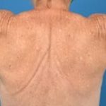 Brachioplasty Before & After Patient #1336