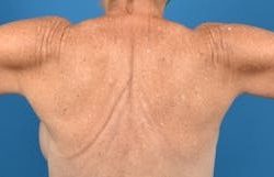 Brachioplasty Before & After Patient #1336