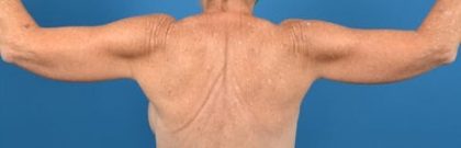 Brachioplasty Before & After Patient #1336