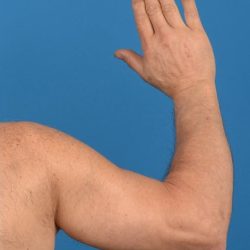 Brachioplasty Before & After Patient #1292