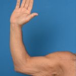 Brachioplasty Before & After Patient #1292