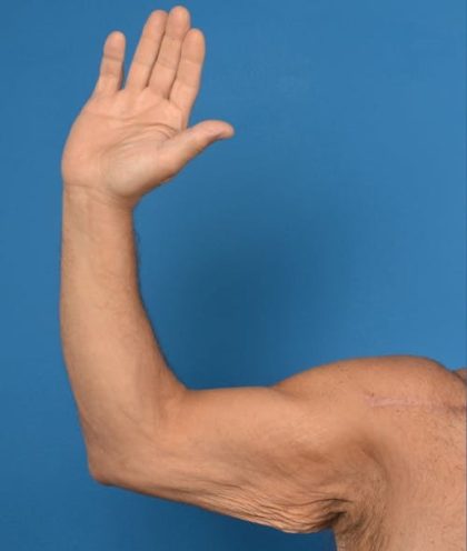 Brachioplasty Before & After Patient #1292