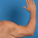 Brachioplasty Before & After Patient #1292