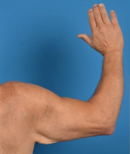 Brachioplasty Before & After Patient #1292