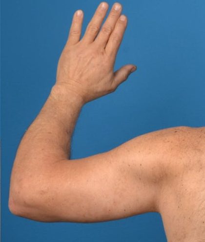Brachioplasty Before & After Patient #1292