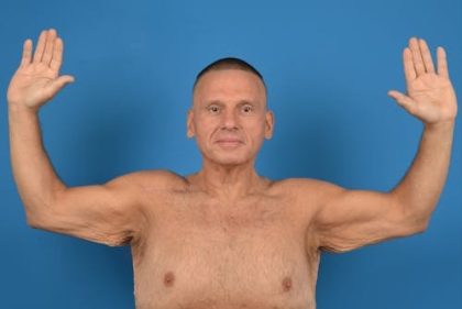 Brachioplasty Before & After Patient #1292